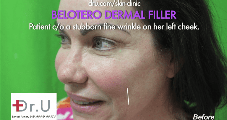White line shows where the Belotero dermal filler would be applied to eliminate the unwanted wrinkle White line shows where the Belotero dermal filler would be applied to eliminate the unwanted wrinkle