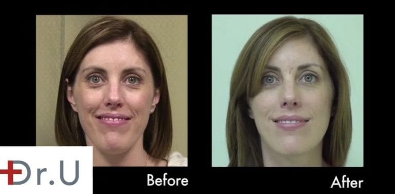 Hyaluronic acid fillers may be the best dermal filler injection for the early onset of laugh lines (nasolabial folds) 
