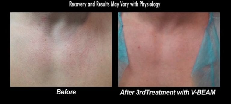 Before and after images show patient's chest after his third and final treatment with the Vbeam laser treatment for Rosacea
