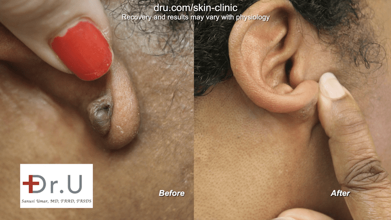 The large hard lump on the earlobe from keloid formation is no longer present