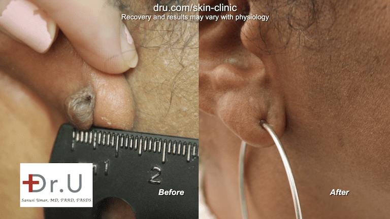 Brentwood patient is now able to wear her favorite earrings after her earlobe keloid removal surgery performed by Dr.U