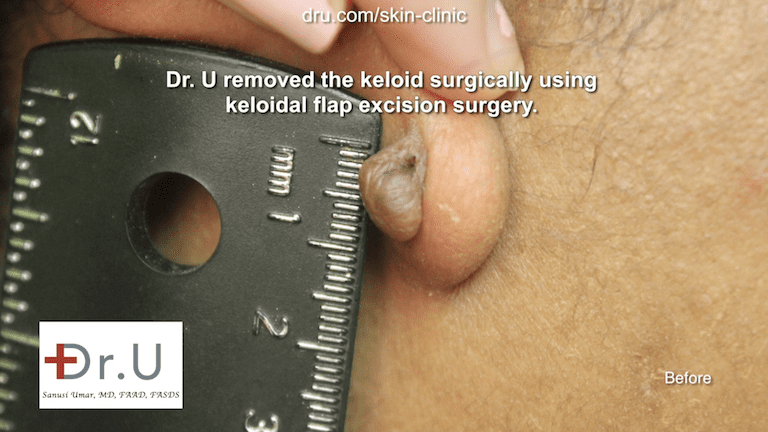 At almost one centimeter in length, surgery was needed to get rid of keloid on the earlobe
