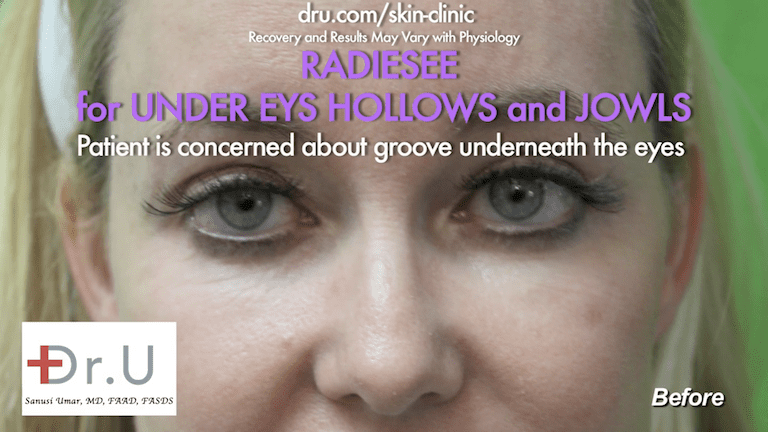 In addition to wanting to know how to get rid of jowls , the Manhattan Beach patient was also concerned about the hollows underneath her eyes, so Dr. U recommended Radiesse as an under eye hollows filler