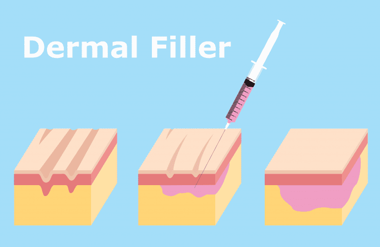 A rudimental illustration that shows how dermal fillers can be used to lift sagging jowls without surgery.