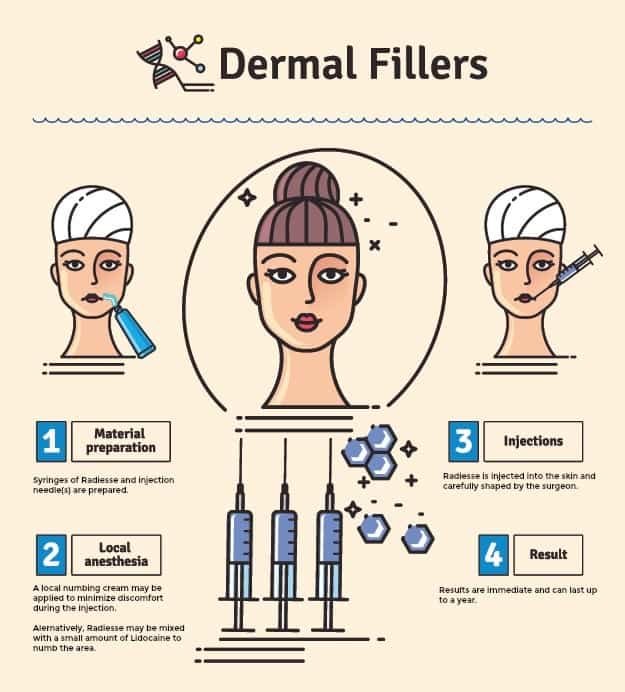 The jowl and under eye hollows filler Dr. Umar chose for this Manhattan Beach patient was Radiesse, a calcium hydroxyapatite based gel. This infographic shows the process of how to get rid of jowls with Radiesse.