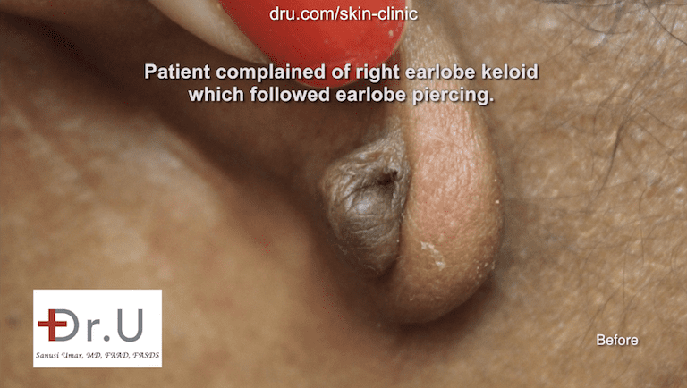 Brentwood, Los Angeles patient with keloid growth on earlobe before her surgical treatment with Dr.U