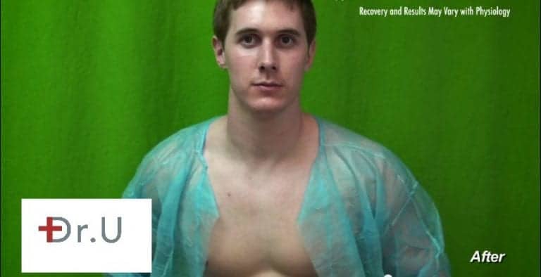 Vbeam proved to be the best Rosacea treatment for this Manhattan Beach patient's chest redness