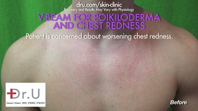 Patient showing redness on his chest before his laser treatment for rosacea
