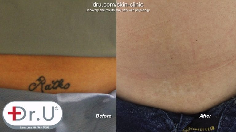 The Manhattan Beach patient was pleased with the results of her laser tattoo removal before and after her final session. The Manhattan Beach patient was pleased with the results of her laser tattoo removal before and after her final session.