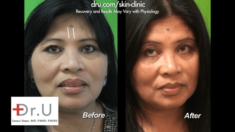 The white line shows where the application of the Belotero dermal filler will go to eliminate the unwanted 11's