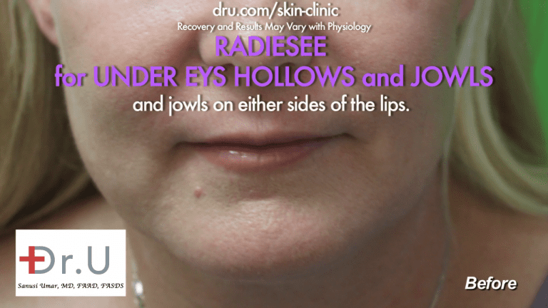The Manhattan Beach patient wanted to know how to get rid of jowls without surgery, so she consulted Dr. U in his Los Angeles clinic.