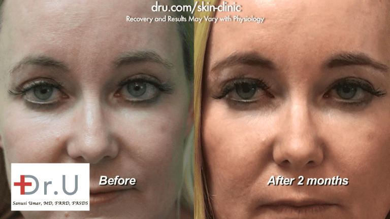 Successful treatment with dermal fillers for under eye bags before and after as seen on the Manhattan Beach patient at the Dr. U Skin Clinic