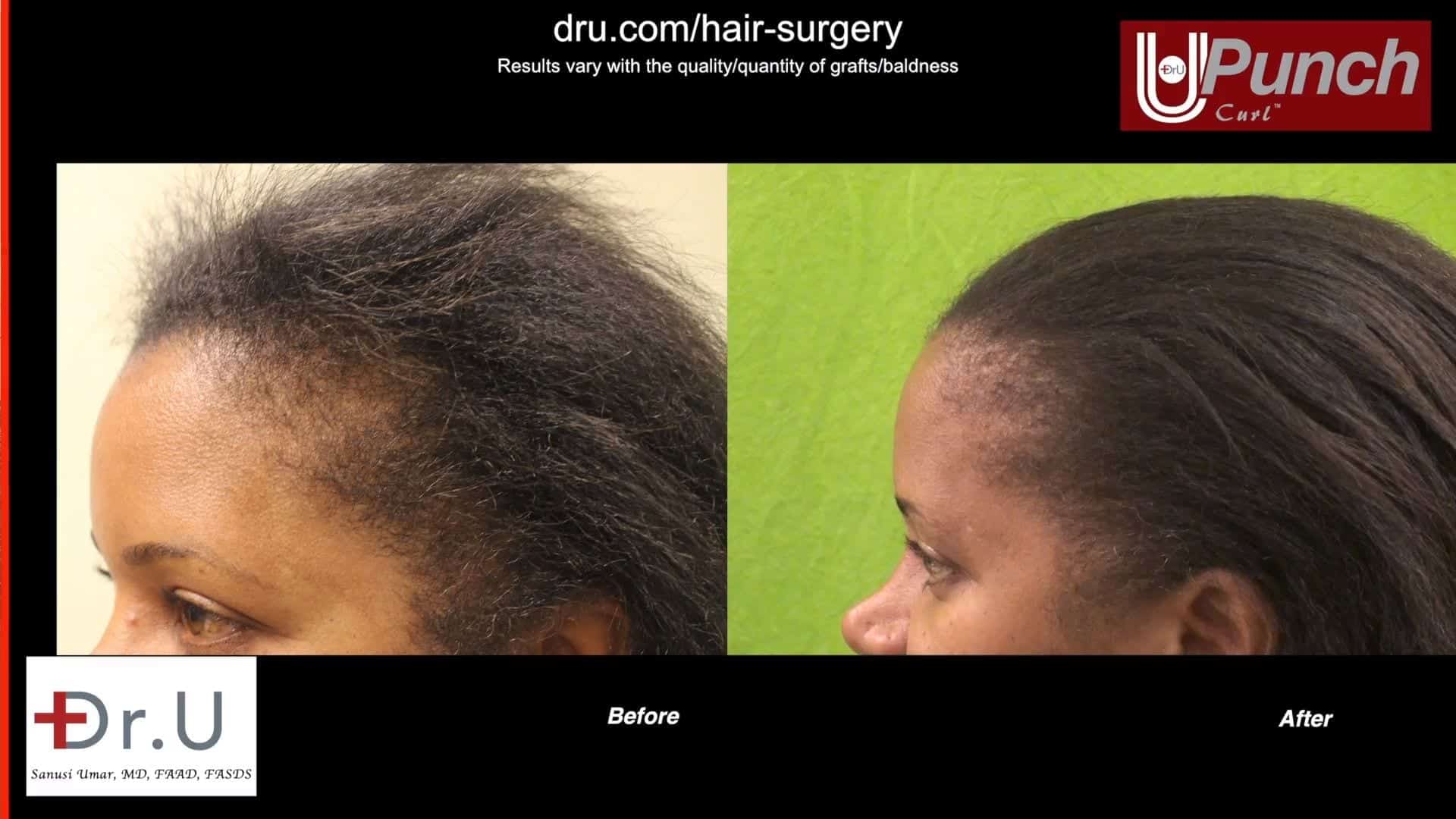 Can Traction Alopecia Be Reversed? African American Patient Gets Dr.UGraft Procedure to Reverse Permanent Hair Loss.