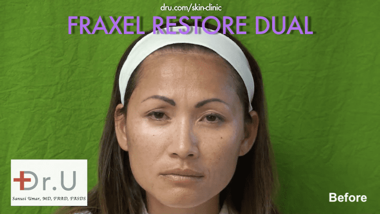 Beverly Hills patient sought fractional laser skin resurfacing for sunspots, mild-moderate wrinkles, and enlarged pores