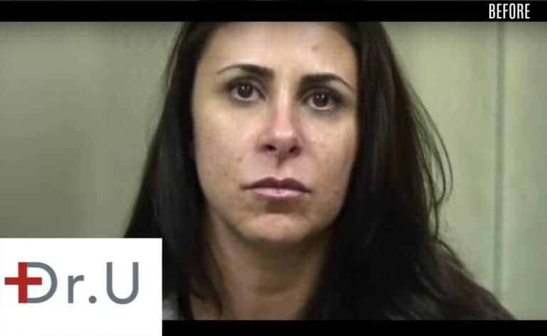 Westlake Village, Los Angeles patient before her treatment with a laugh lines filler.