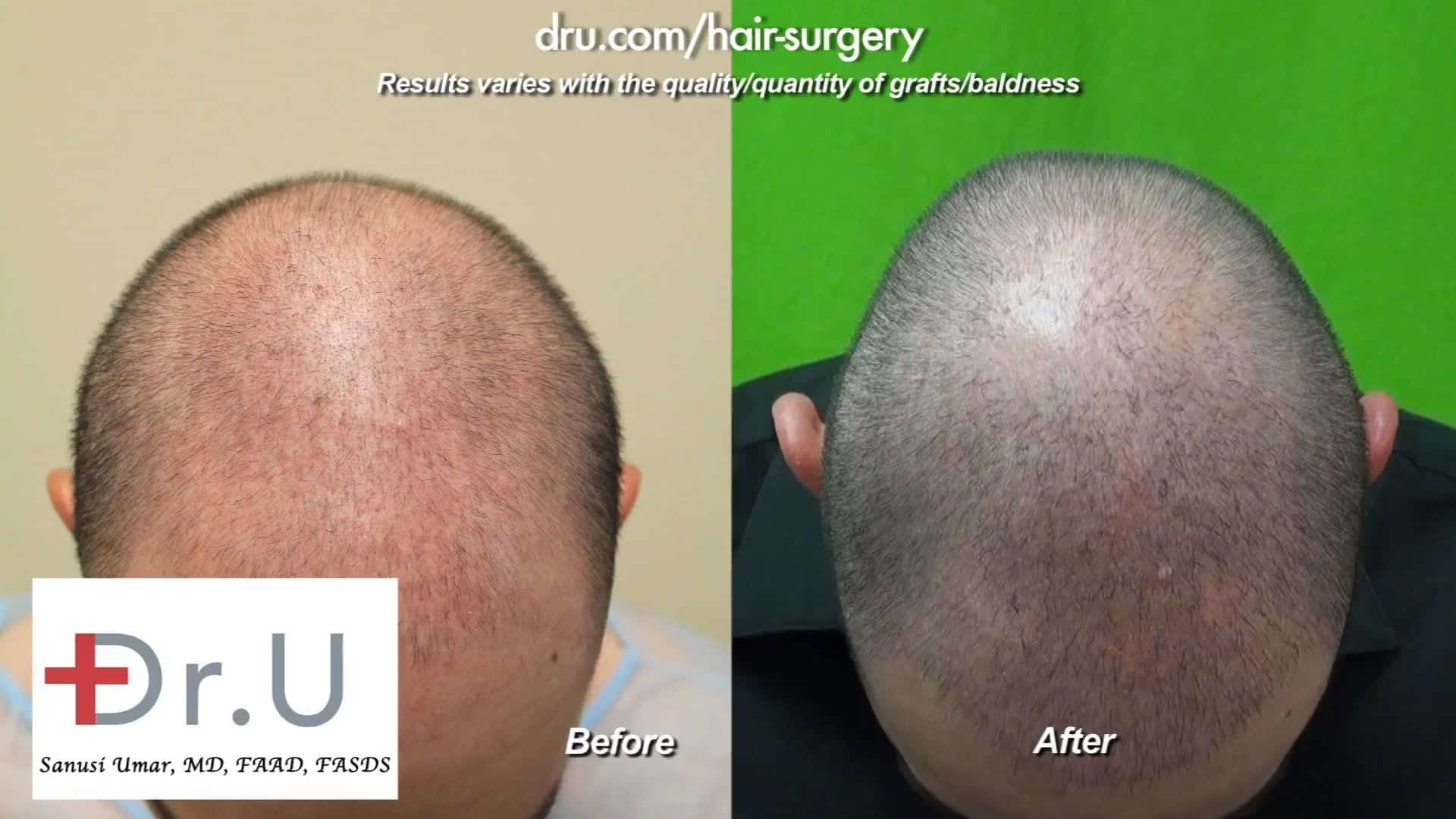 Young Hair Transplant Patient Opts for a Less-is-More Approach