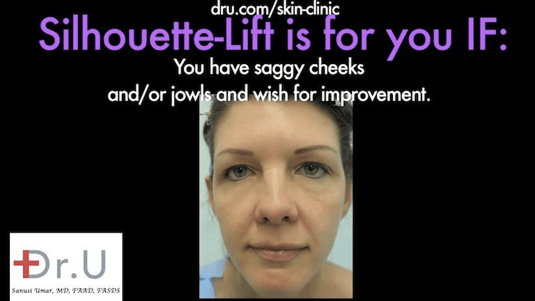 Beverly Hills patient with deep laugh lines before her Silhouette Lift procedure.