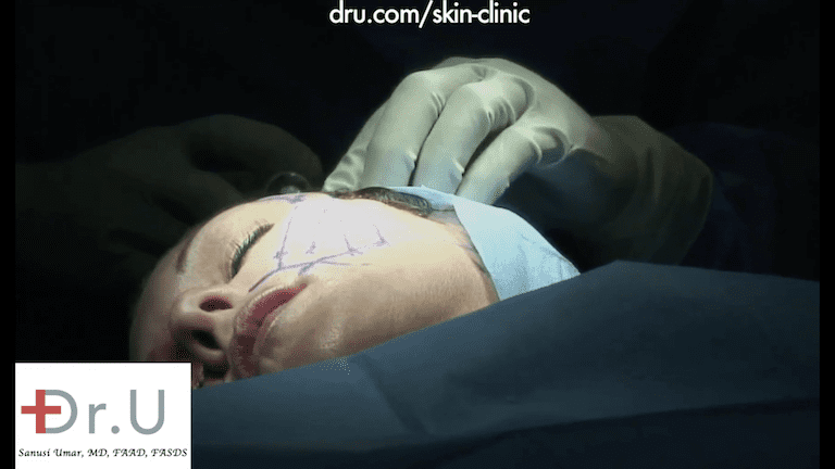 Dr. U marks the patient's face for her Silhouette Lift procedure.