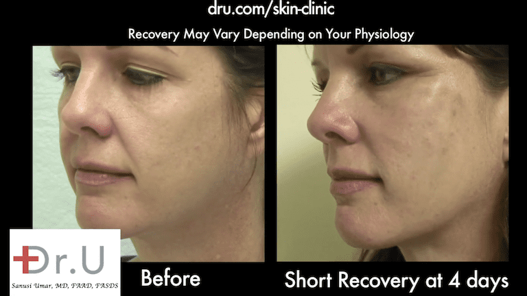 Nonsurgical facelift before and after photos show a firmer appearance in the patient's cheeks.