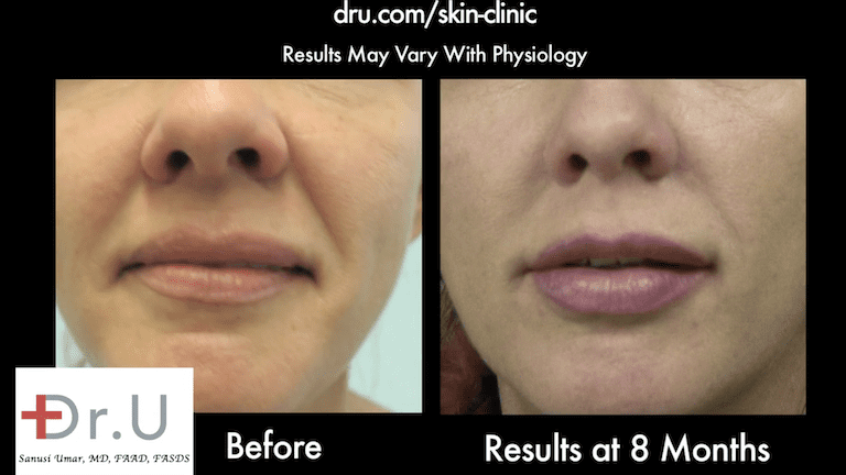 Dr. U's Silhouette thread face lift helped pull back patient's sagging cheeks.