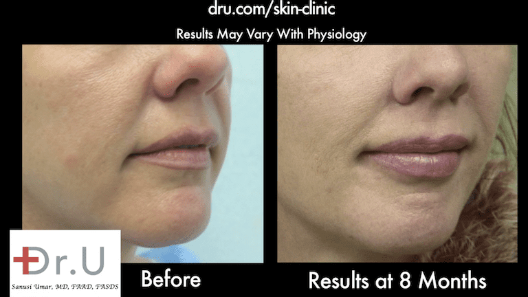 Dr.U's  Silhouette non surgical Lift, combined with hyaluronic acid filler, created an incredibly natural looking improvement for the laugh line and cheeks.