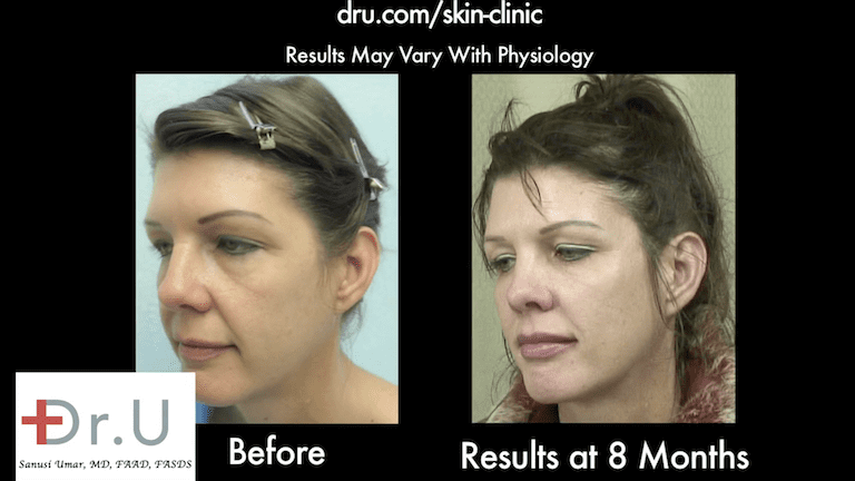 Patient's drooping cheeks no longer produce an overlap, folding effect after treatment with Dr.U's  Silhouette Lift and fillers.