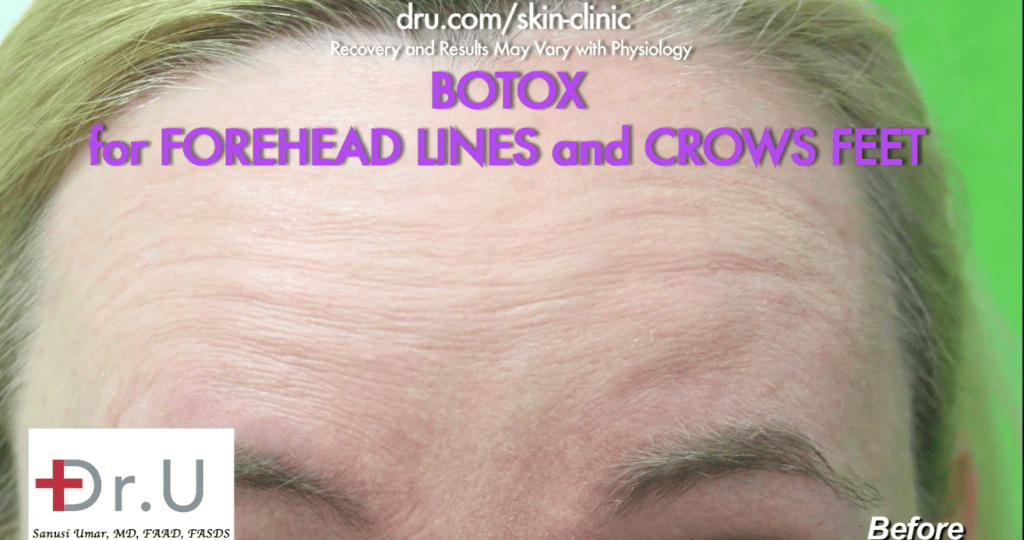 Beverly Hills patient before procedure using Botox for forehead wrinkles.