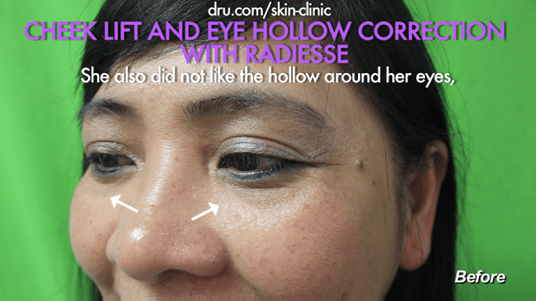 Patient from El Segundo wanted to fix sunken under eye hollows.