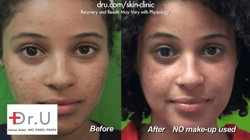 The patient is very happy with her results from Dr. U Skin Clinic after her Fraxel Dual laser treatment for acne scars.* The patient is very happy with her results from Dr. U Skin Clinic after her Fraxel Dual laser treatment for acne scars.
