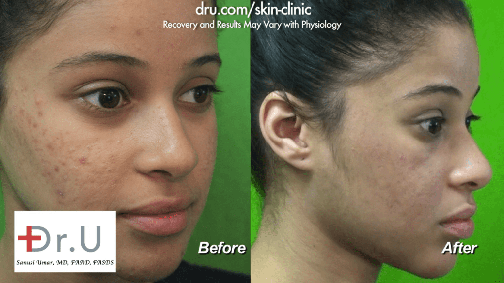 After searching high and low for an "acne laser treatment near me", this Santa Monica patient was pleased to find the Dr. U Skin Clinic. She is happy with her Spectra laser treatment results. After searching high and low for an "acne laser treatment near me", this Santa Monica patient was pleased to find the Dr. U Skin Clinic. She is happy with her Spectra laser treatment results.