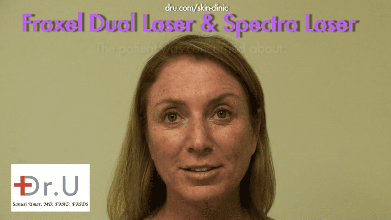 This patient from El Segundo, Los Angeles consulted Dr. U about age spots on face and neck areas. The appearance of the brown dots concerned her. 