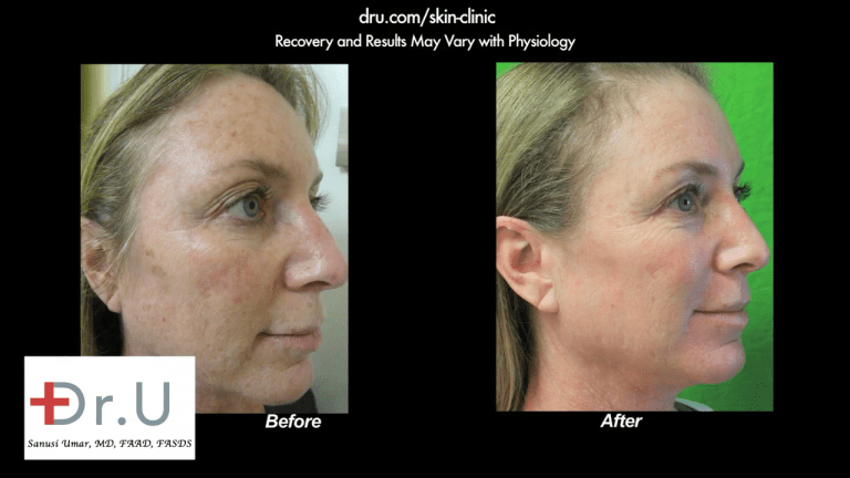Profile view showing the other side of the patient's face after undergoing the best age spot remover treatment with Dr. U in Los Angeles.*