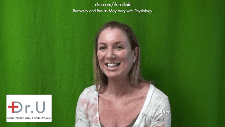 The patient was very happy and would recommend treatment with Dr. U to anyone wondering how to remove age spots on face.