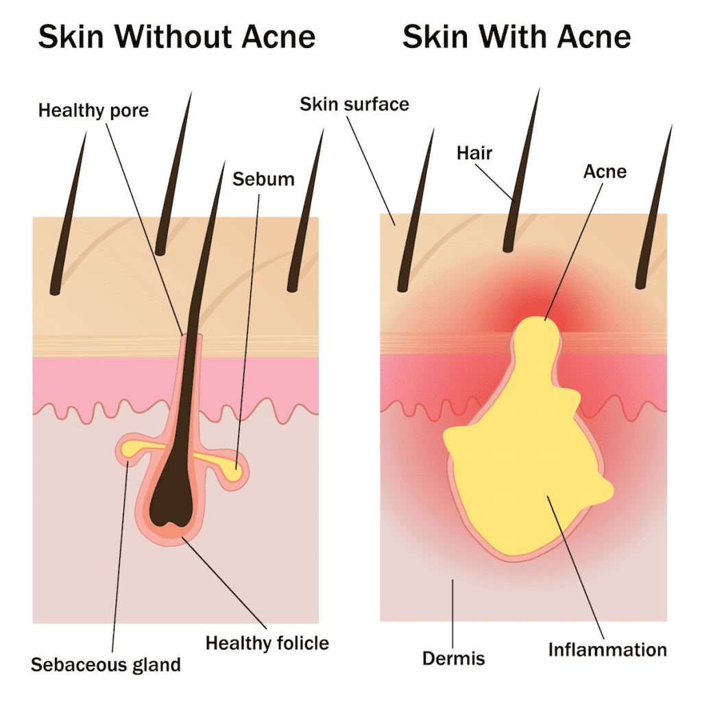Acne is the result of an inflamed or infected sebaceous gland. Laser therapy can be an effective way to target these inflamed glands. Acne is the result of an inflamed or infected sebaceous gland. Laser therapy can be an effective way to target these inflamed glands.