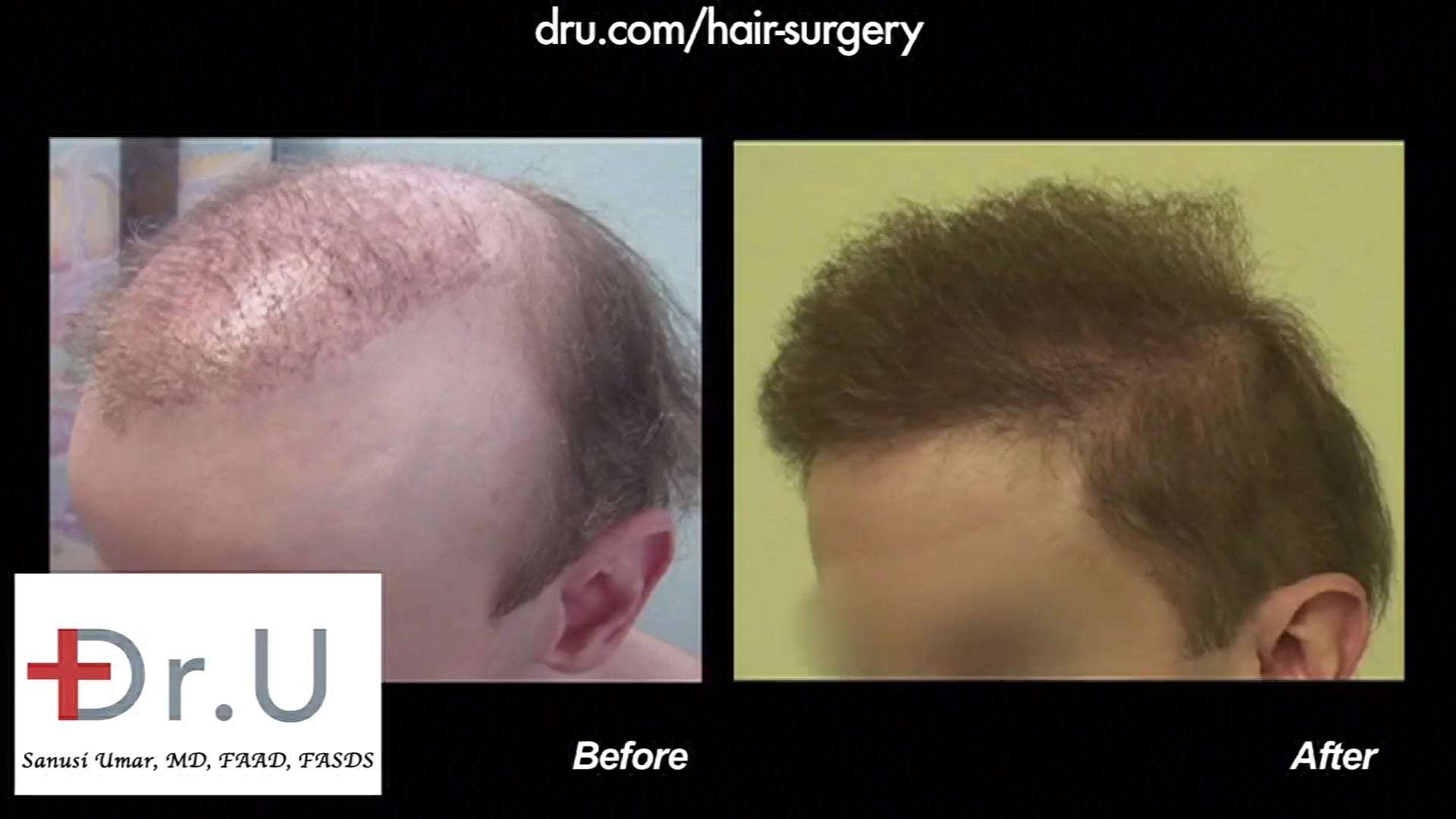 Hair Restoration Disaster Reversed By Body Hair Transplant