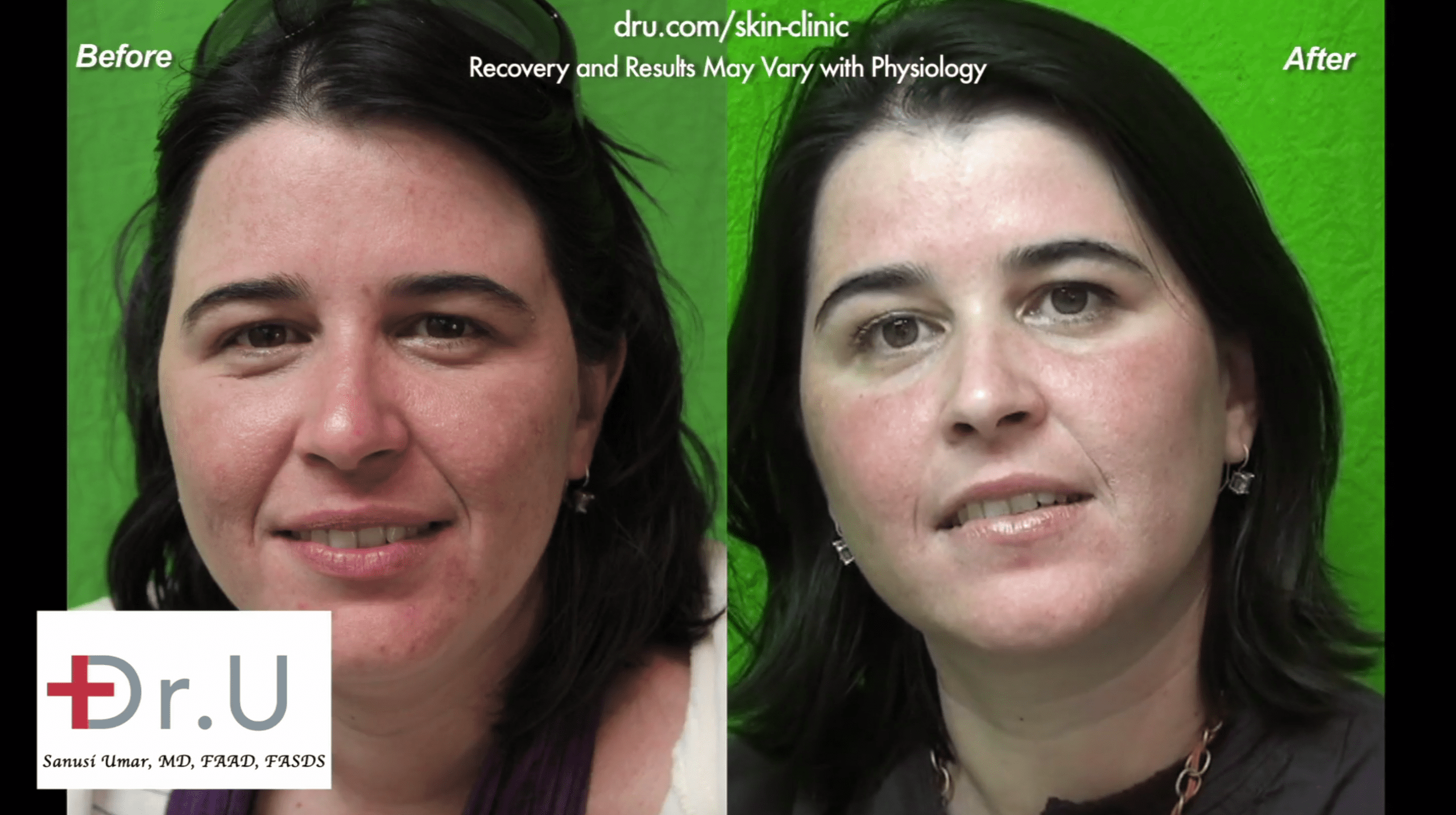 This patient found relief from adult acne at Dr. U Skin Clinic. This patient found relief from adult acne at Dr. U Skin Clinic.*