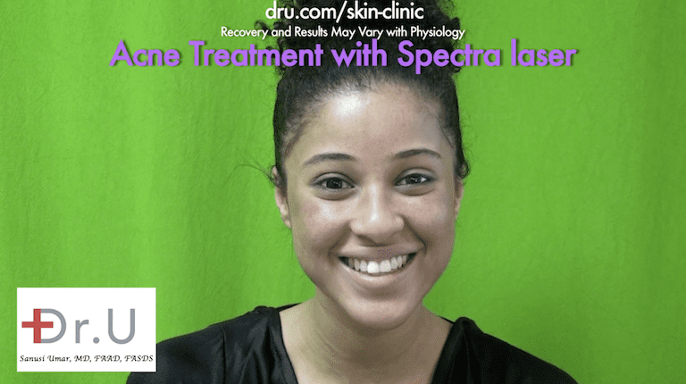 The patient is happy with her Spectra laser skin acne treatment at Dr. U Skin Clinic.* The patient is happy with her Spectra laser skin acne treatment at Dr. U Skin Clinic.