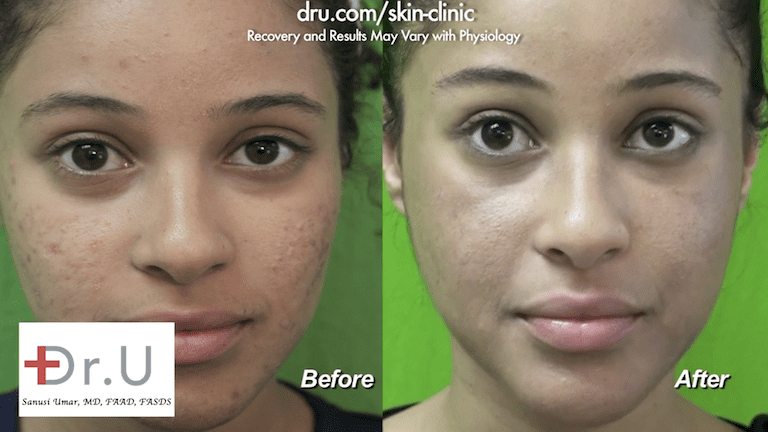 The patient was happy to see the results of her laser skin acne treatment. After targeting the remaining acne, Dr. U focused on the acne scars underneath.* The patient was happy to see the results of her laser skin acne treatment. After targeting the remaining acne, Dr. U focused on the acne scars underneath.*