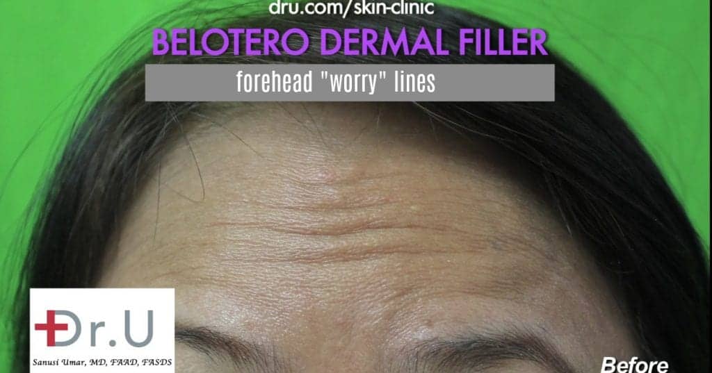 Manhattan Beach patient hopes for improvement using Belotero for forehead wrinkles