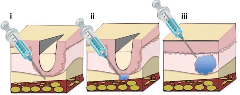 Fillers for laugh lines work by raising the depression in the skin caused by creases and wrinkles. Image courtesy of Plastic and Aesthetic Research.