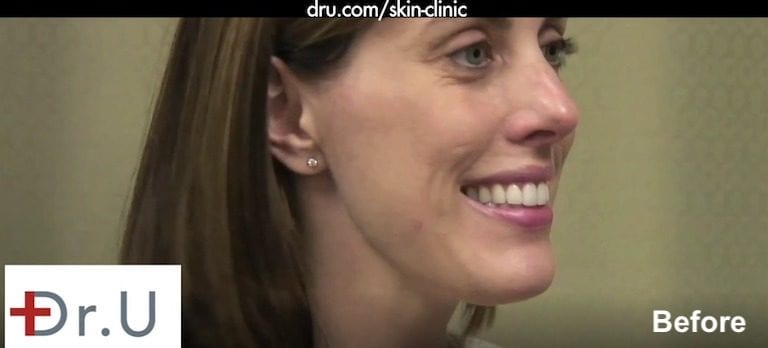 Right side of patient's face before treatment with hyaluronic acid fillers for laugh lines