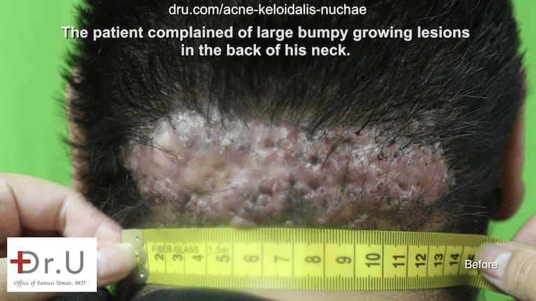 After consulting Dr. U about his condition, the Los Angeles patient was ready to get rid of it. Head bumps after shaving are often overlooked, but they can be early signs of AKN.