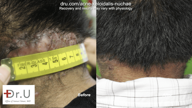 Dr. U used his unique excision shape for this patient's AKN hair bumps on back of head.*