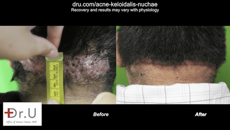Before and after results of Los Angeles patient at Dr. U Skin Clinic. The patient was happy to be free of razor bumps on head, which had previously made him self-conscious.