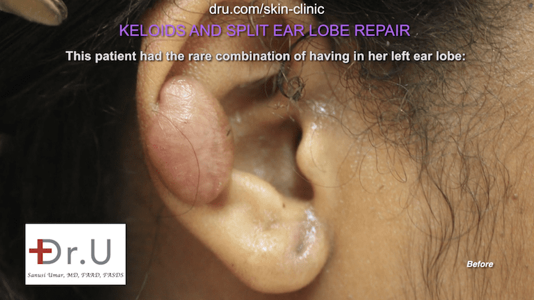 On the other ear, the patient also had an earlobe keloid towards the top of the front of her ear. This was a source of concern and embarrassment for the patient.