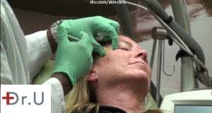 Dr. U injects Botox for crows feet around the eyes