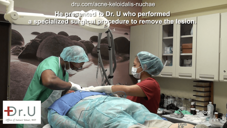 Dr. U removes razor bump back of head for Los Angeles patient. Using his unique excision method, Dr. U helps encourage a cosmetically acceptable scar along the back hairline.