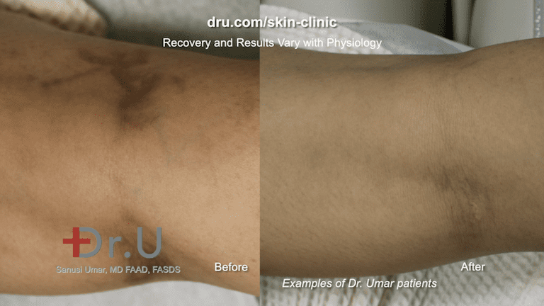 Before and after varicose veins in forearms treatment. This patient was treated by our team for spider veins, which may be associated with deep veins of the leg.*