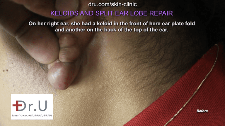 In addition to the earlobe keloid on her right ear, the patient had another on the back, on top.