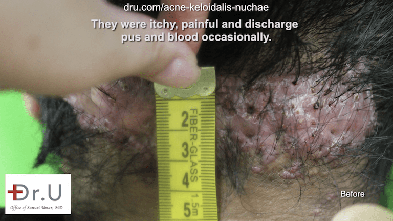 For large razor bumps on head that have joined together, Dr. U typically recommends surgical removal.